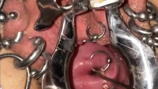 Extreme cervix sounding