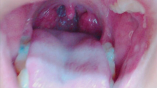 Tongue, Tonsils, and Throat Examination